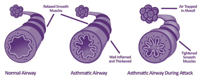 Diagram showing normal vs asthmatic airways. An asthmatic airway has inflamed and thickened walls.