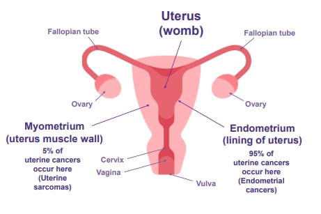 A graphic of a uterus showing where uterine cancer may develop.