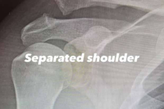 Channing Tatum shares X-ray images before and after shoulder surgery
