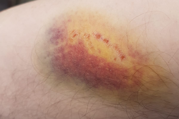 A bite mark was left on an NSWNMA member after being injured by a patient during a shift.