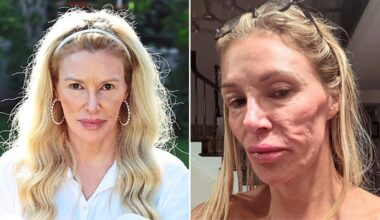 Brandi Glanville Says Her Face Is ‘Sinking in Again’ Amid Ongoing Health Battle