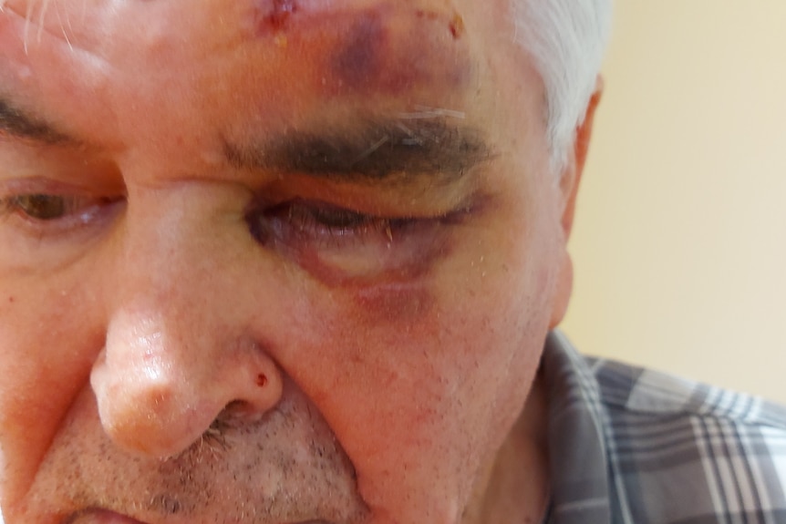 A close up image of an elderly man with multiple bruises on his face.