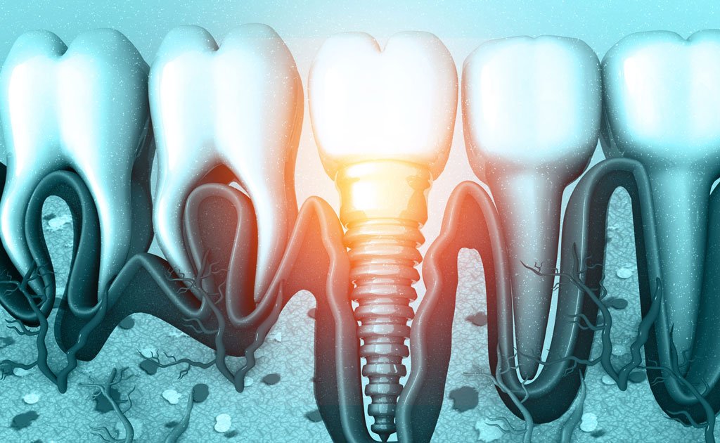 why antibiotics fail against a common dental implant disease