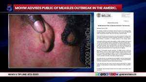 Belize on High Alert After Health Officials Confirm 12 Measles Cases