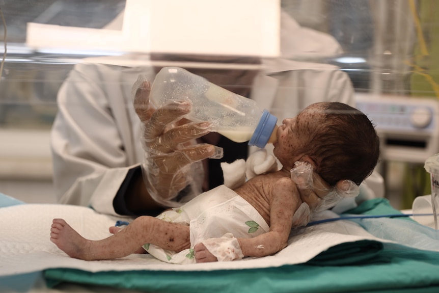 A Gazan baby with chickenpox drinks from a bottle in a hospital cot.