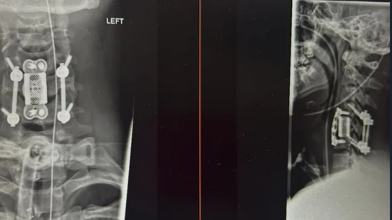 An x-ray showing bones and screws
