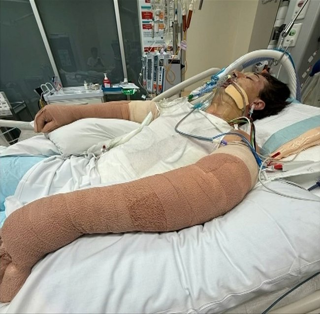 Perrem suffered burns to about 75 per cent of his body.