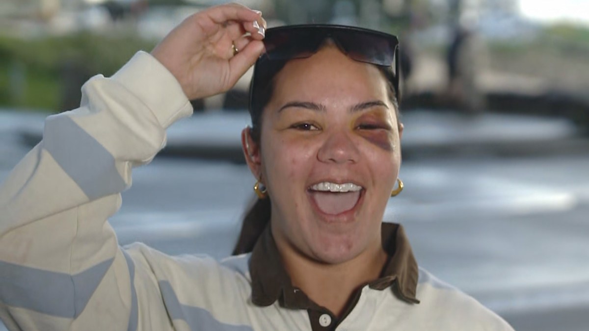 NRLW news 2026: Kennedy Cherrington injury update, orbital fracture, Parramatta Eels, Women in League round