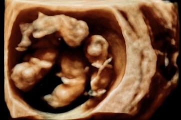 An ultrasound image of four fetuses in utero