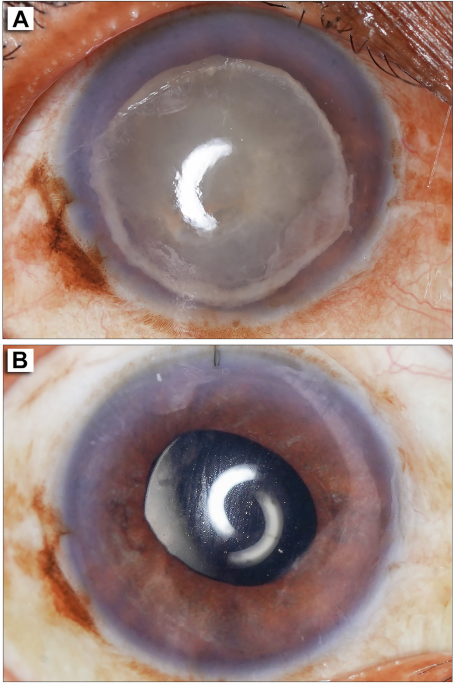 A phantom lens in the anterior chamber: a deceptive presentation of phacolytic glaucoma