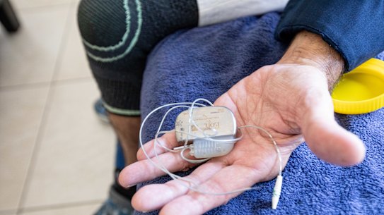 A spinal cord stimulator.