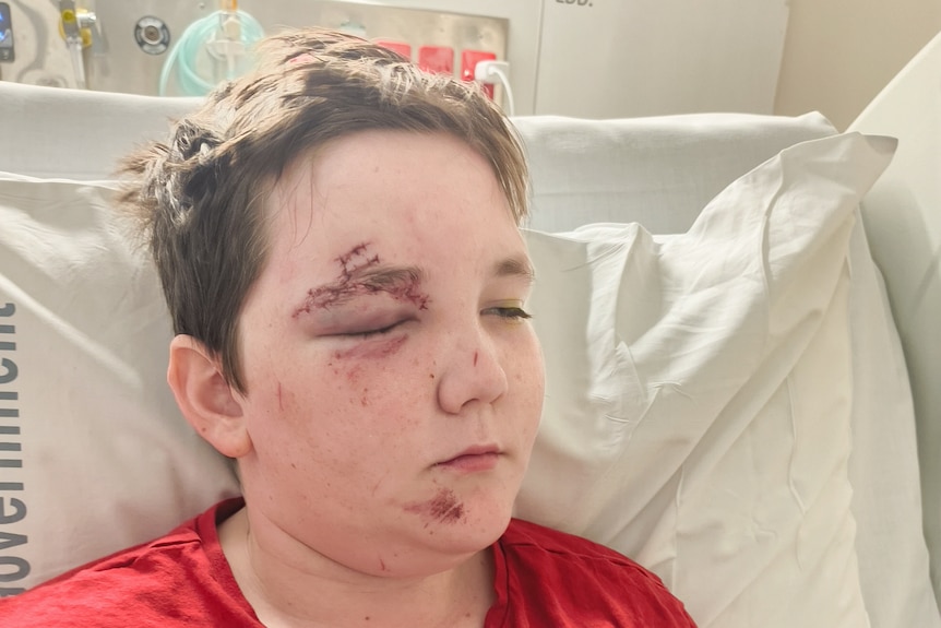 A boy with a bruised eye lies in a hospital bed