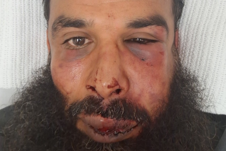 A photo of Samir, close up, showing his eye and lip damaged and bruised.