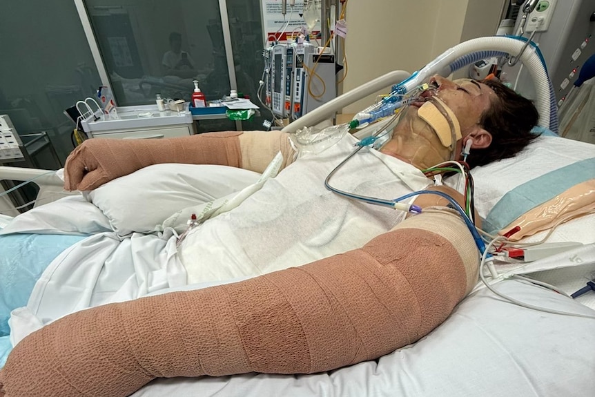 A critically ill man is asleep in hospital with breathing tubes
