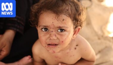 Gaza's babies suffer deadly chickenpox outbreak