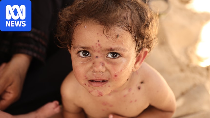 Gaza's babies suffer deadly chickenpox outbreak