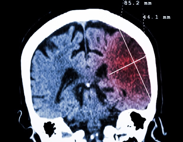 New viral insights lay foundation for treating infection with JC polyomaviruses