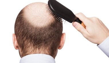 GLP-1 receptor agonists may increase hair loss risk