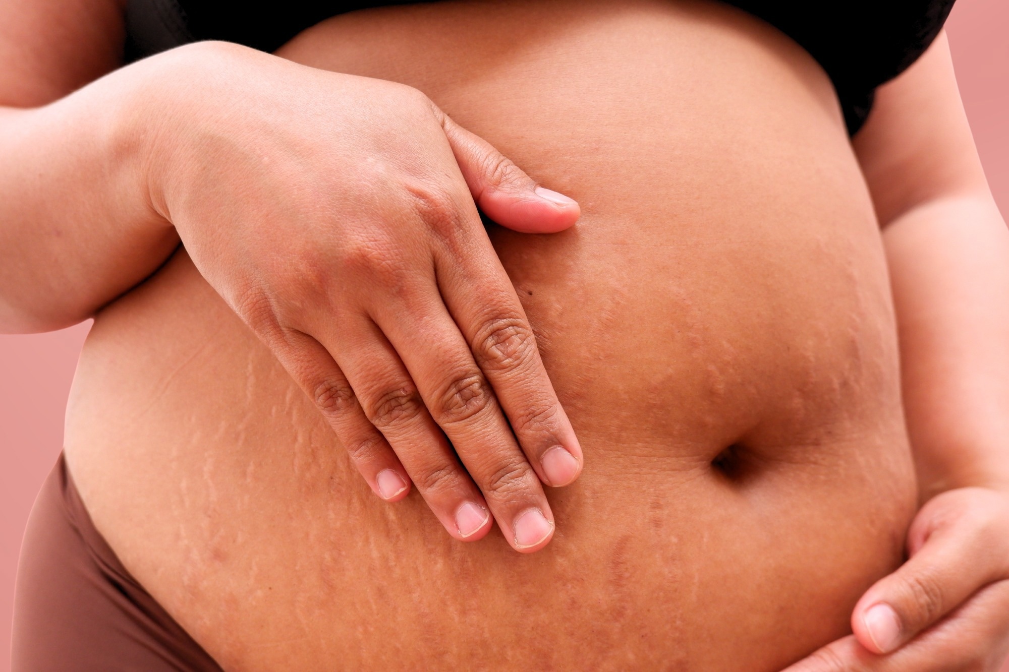 Study: Pregnancy outcomes following maternal GLP-1 receptor agonist exposure: a systematic review and meta-analysis. Image Credit: While of My Desk / Shutterstock