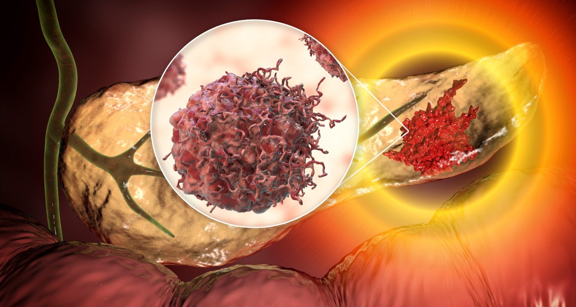 Red meat intake emerges as a potential pancreatic cancer risk factor