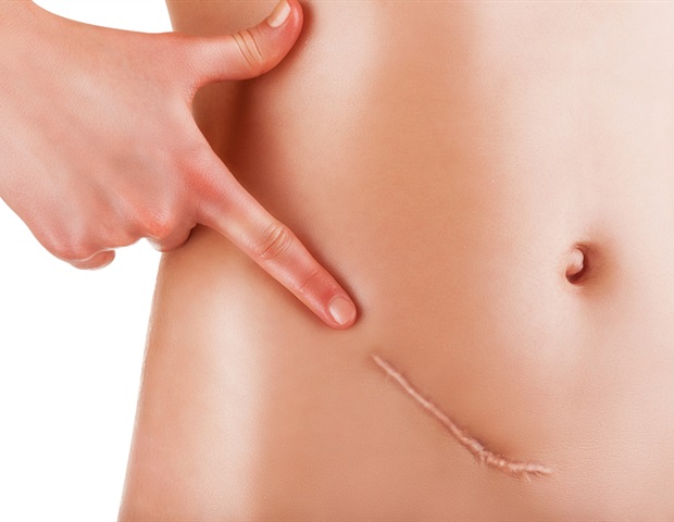 Wistar scientists develop new bispecific T cell engager to target ovarian cancer