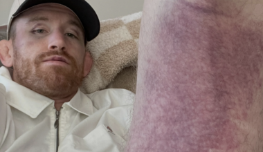 Cory Sandhagen Fears Torn Hamstring After UFC 329