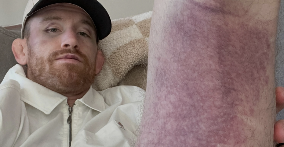 Cory Sandhagen Fears Torn Hamstring After UFC 329