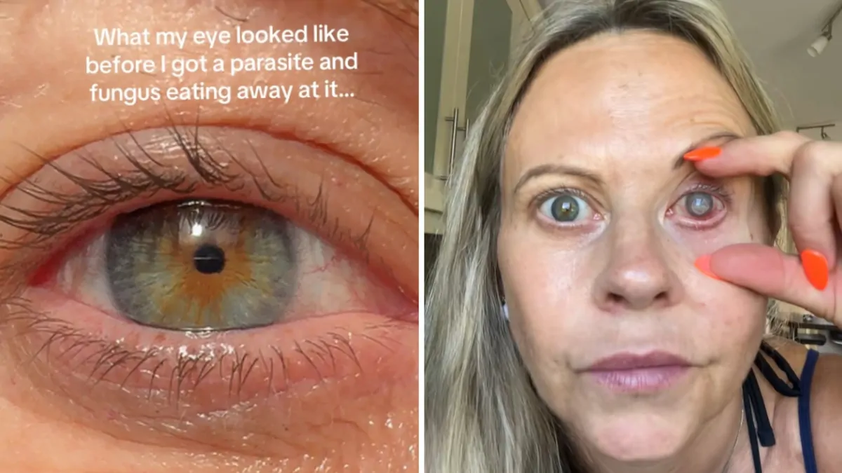 Emma Marsden: Lancashire woman may lose vision after parasite burrows into cornea