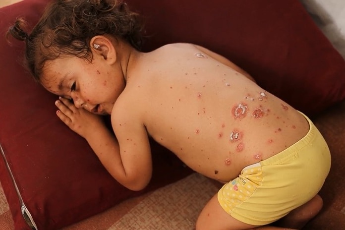 A Gazan toddler with chickenpox napping on a red pillow in a tent.