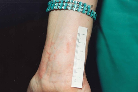 A close up shot of the inside of a wrist covered in scratches, with a blue beaded bracelet and a tape measure on it