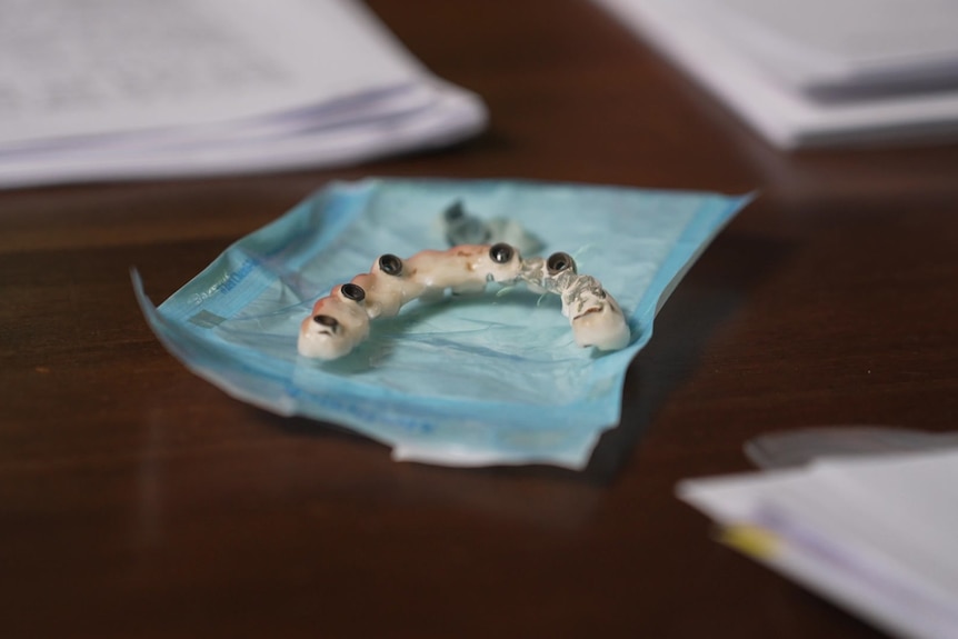 A dental prosthesis