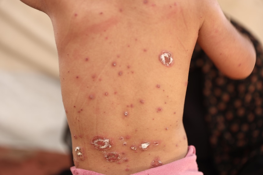 A Gazan baby with skin pockmarked by blisters and rashes caused by chickenpox.