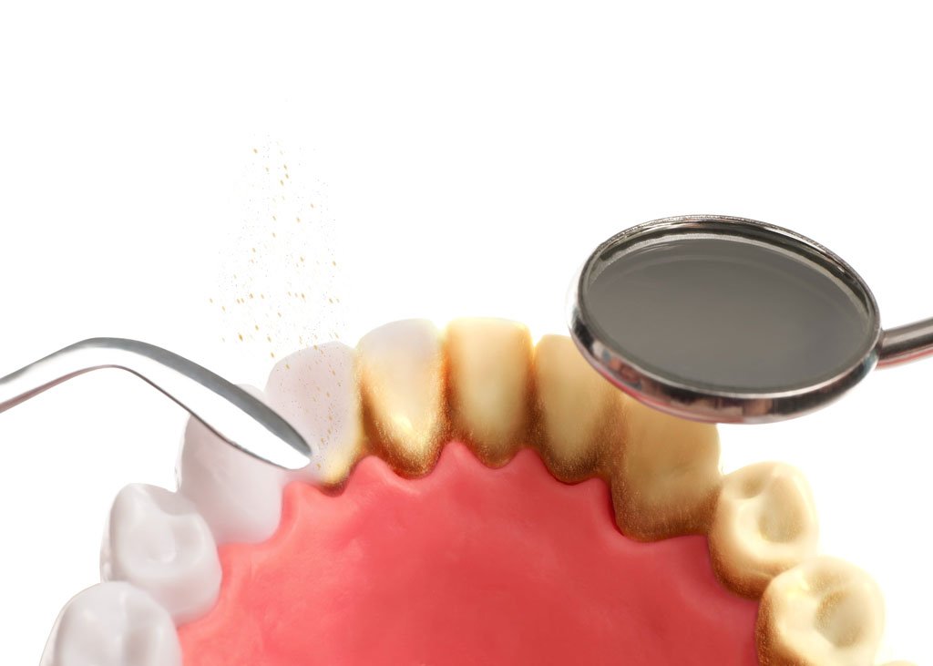 Cryo-EM helps identify the mechanisms of dental plaque formation