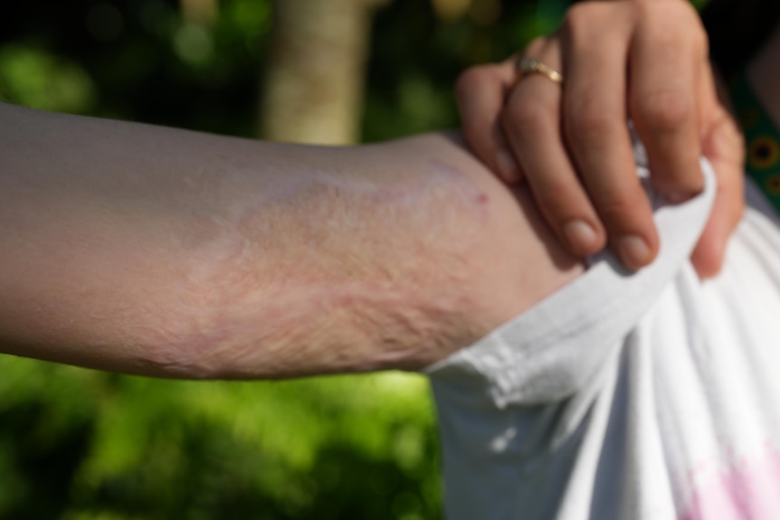 Girl's arm with scars