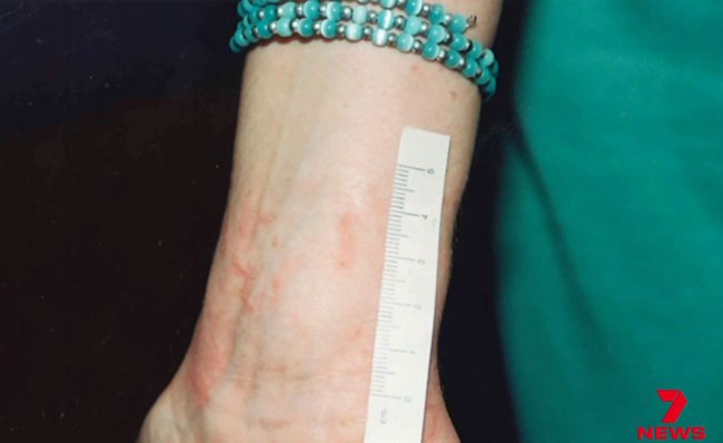 Injuries to Joanne from restraints