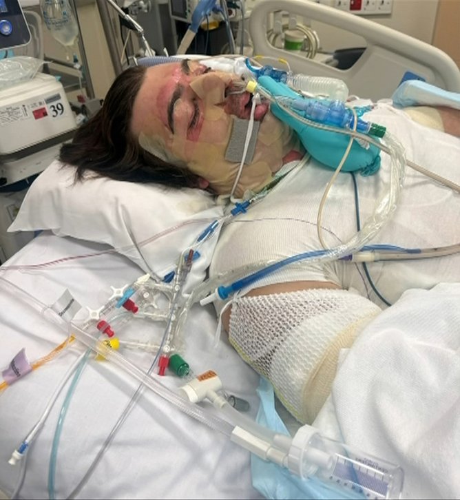 Lachie Perrem was severely injured after a vacuum exploded.