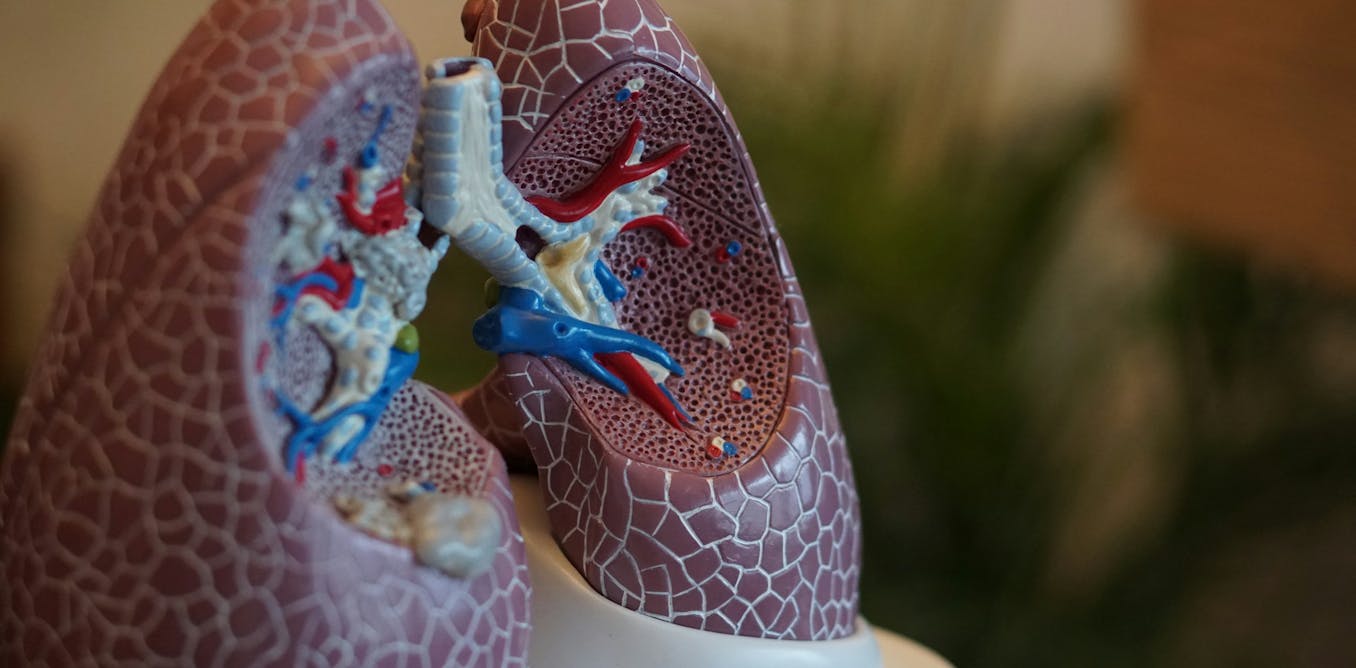 Australia’s lung cancer screening program is a year old. But can the health system deliver?