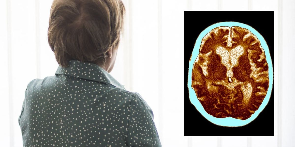 Dementia: Scientists identify physical change that could signal brain decline years before diagnosis