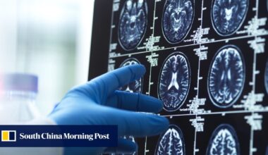 ‘A completely new person’: can surgery help Alzheimer’s patients regain basic skills?