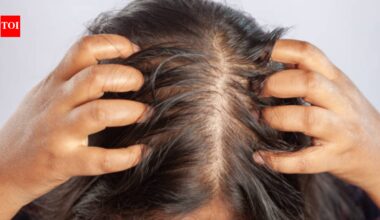 India's fitness boom comes with a hidden cost: Expert reveals what creatine could mean for your hairline |