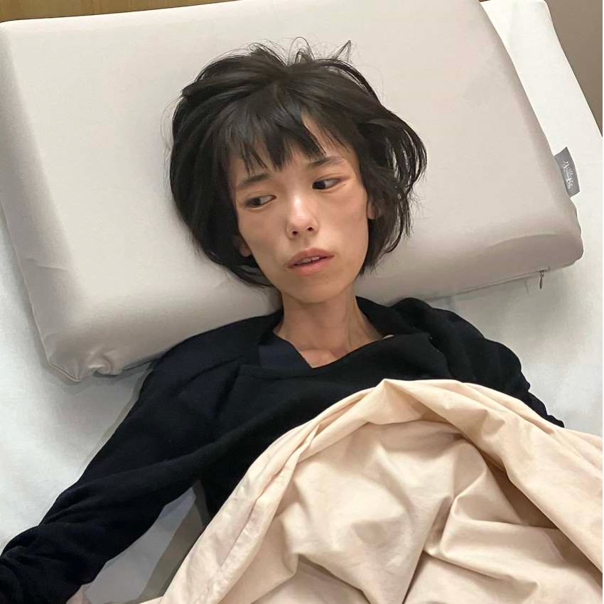 A teenage girl looks emaciated as she lies in a hospital bed.