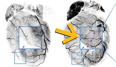 Your Heart Can Actually Build Its Own Bypass After a Heart Attack : ScienceAlert