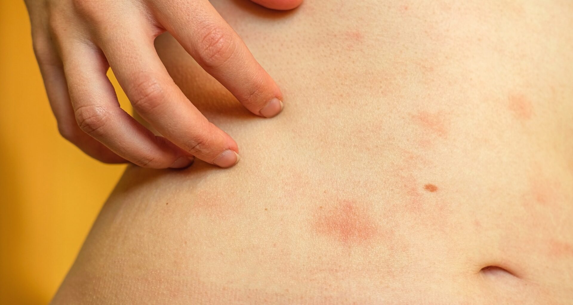 Paying attention to your body may change how an acute skin inflammation unfolds