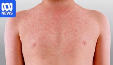 Warnings of possible measles outbreak as study finds 1.7 million Australians are vulnerable