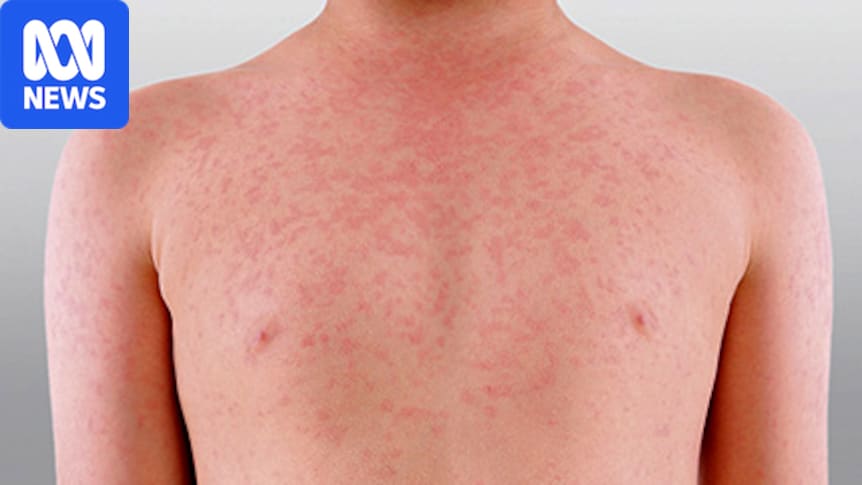 Warnings of possible measles outbreak as study finds 1.7 million Australians are vulnerable