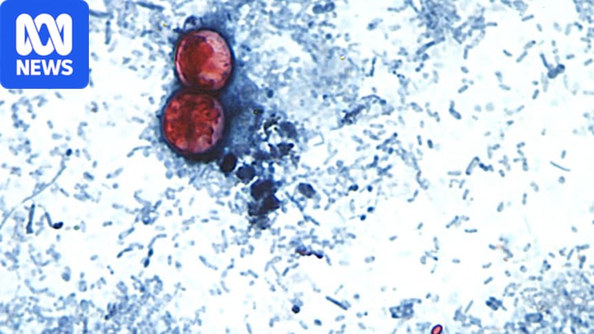 Outbreak of Cyclospora parasite spreads even further across United States