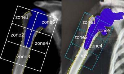 Research reveals bone loss after shoulder replacement surgery • healthcare-in-europe.com