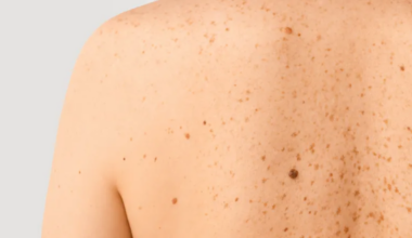 skin cancer