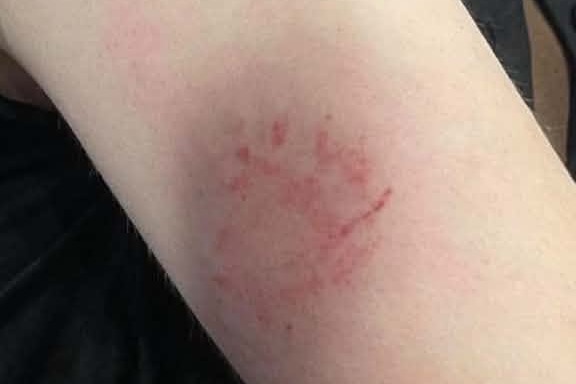 A bite mark on a person's arm.