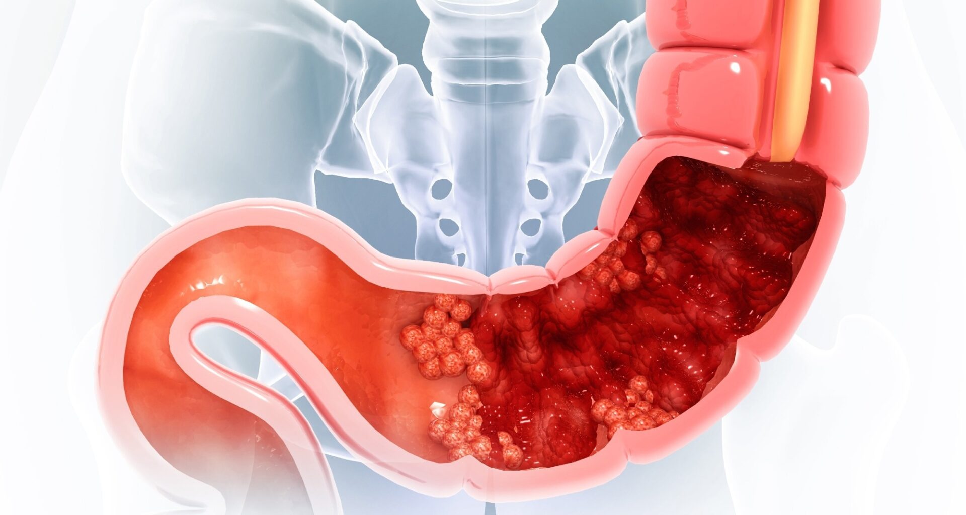 Study: Association of coffee intake with risk of all-cause and colorectal cancer-specific mortality among individuals with colorectal cancer in the Multiethnic Cohort Study. Image Credit: crystal light / Shutterstock